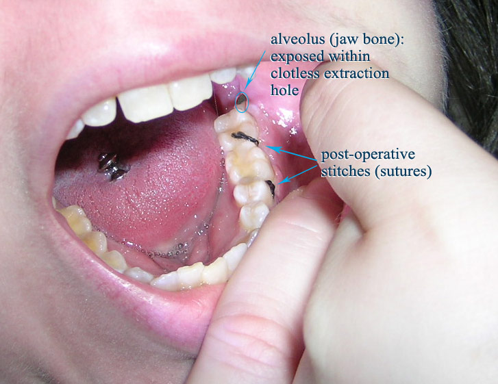 A mouth open with labels and post operative stitches